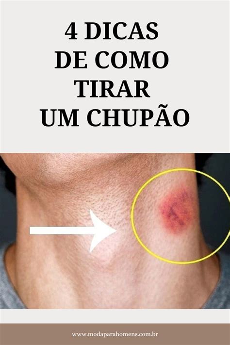 chupão no peito|Como Se Livrar de Um Chupão Da Noite pro Dia: 9 Passos